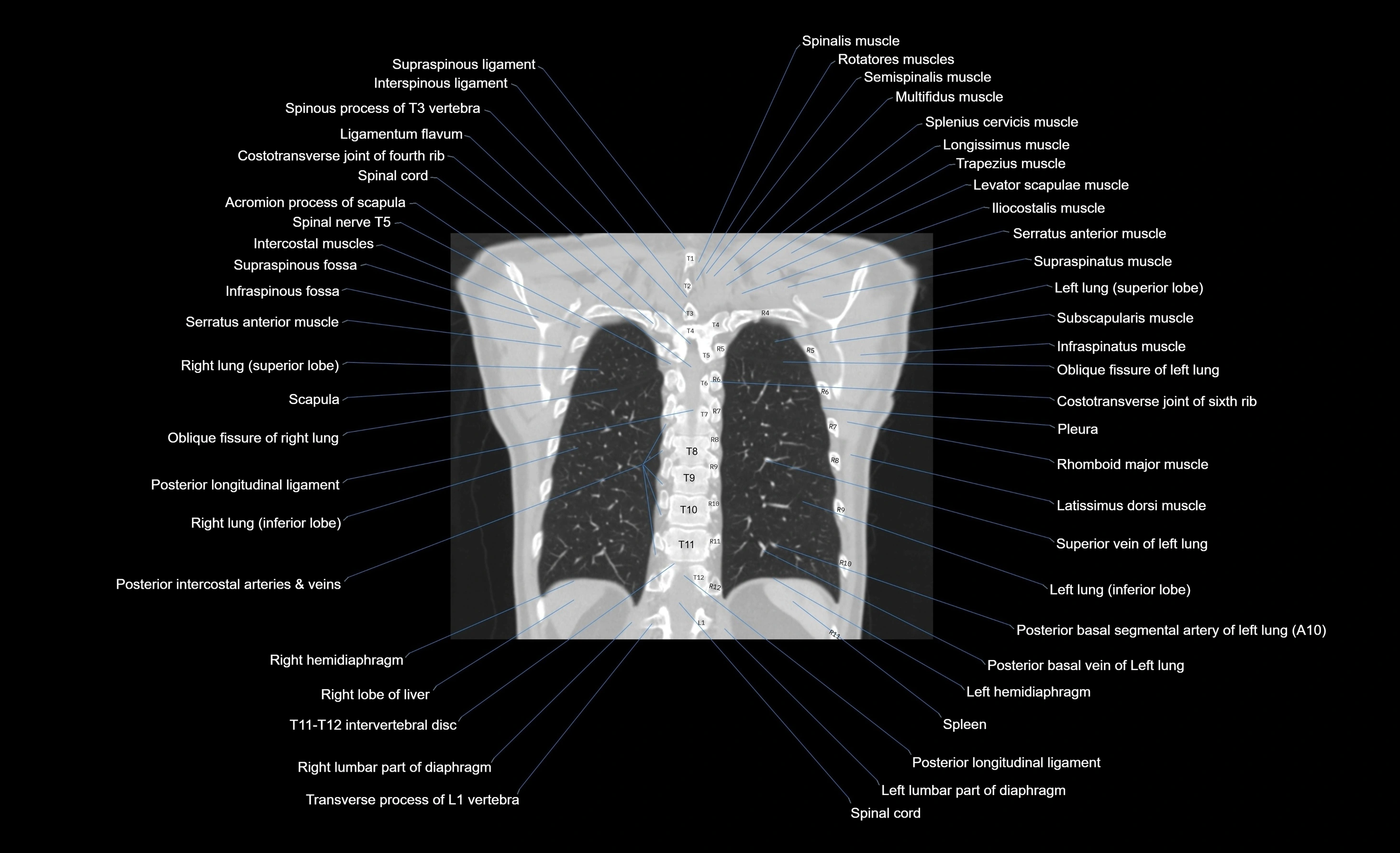 CT chest (thorax) labelled coronal cross sectional anatomy radiology image-00028.webp